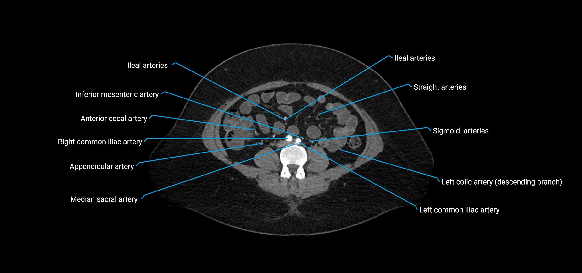 CTA abdomen axial cross sectional anatomy labelled image_134 (2).webp